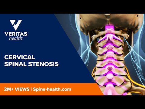 Cervical Spinal Stenosis