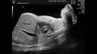 Asvide: Two-dimensional dynamic scanning in the longitudinal section of the neck showed an...