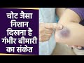 Skin पर चोट जैसा निशान दिखना है Hematoma का संक�