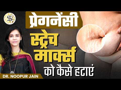 प्रेगनेंसी में स्ट्रेच मार्क्स कैसे हटाएँ | How to Reduce Stretch Marks After Delivery | Skinzest