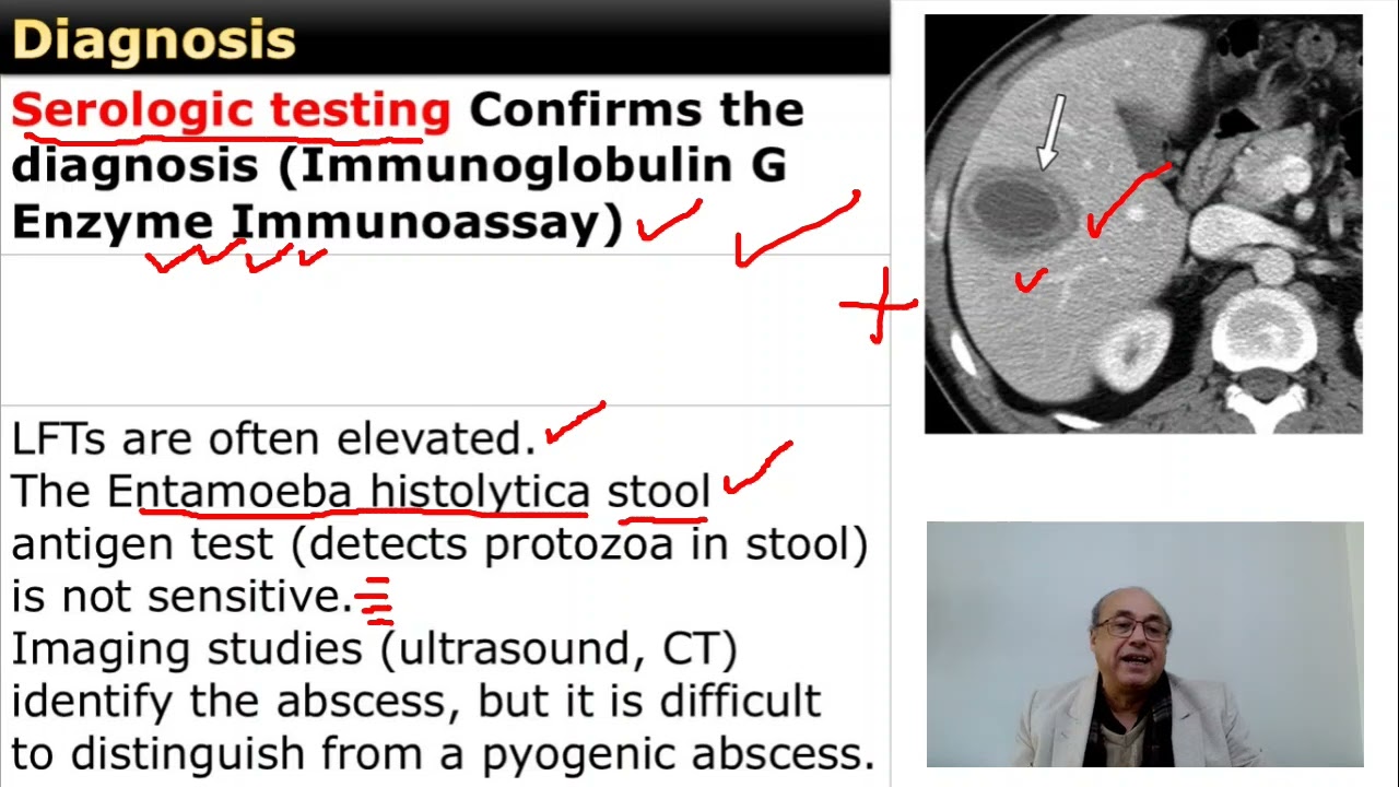Amebic Liver Abscess