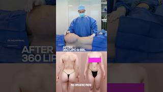 Achieve Your Dream Body With 360 Liposuction And Brazilian Butt Lift Transformation!