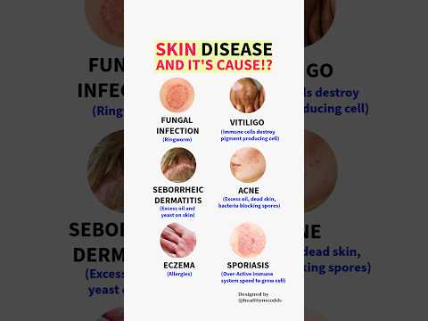 "Skin Disease And It's Cause" #healthyskin #skincare