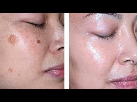 Пигментные пятна от прыщей лечение Маска для лица. для отбеливания кожи