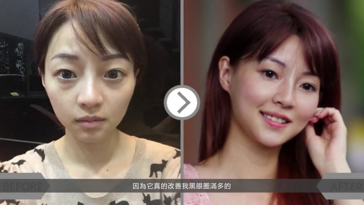 iSkin 盧靜怡皮膚專科診所【玻尿酸】展現內心想要的自己_Amy
