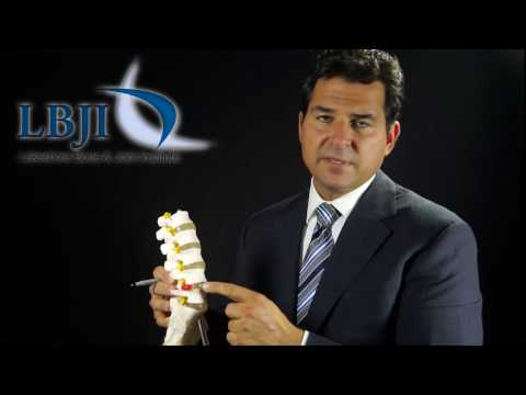 Dr. Nick Nenadovich Explains Lumbar Disc Herniation