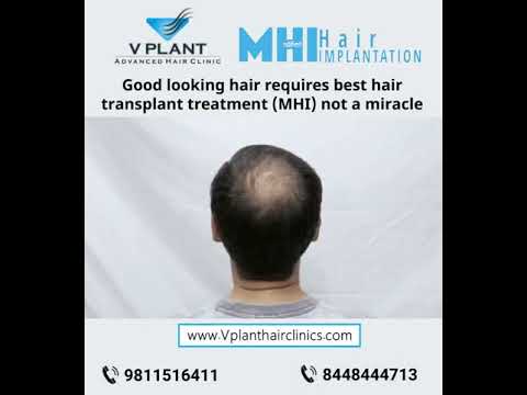 Good looking hair requires best hair transplant treatment (M H I) not a miracle