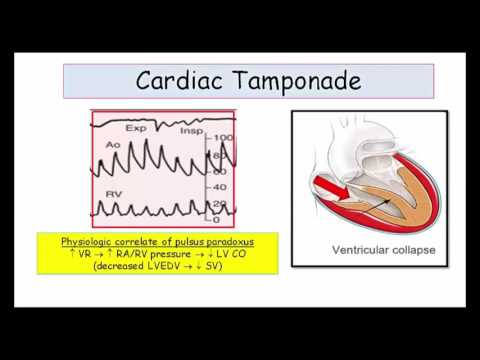12DaysinMarch, Tamponade and Constrictive Pericarditis for USMLE Step One (Part II)