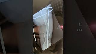 #femur fracture recovery in 2 months X ray #shorts #shortvideo #youtubeshorts