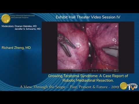 Síndrome de teratoma creciente (STC) - resección de una lesión localizada en el mediastino usando un robot