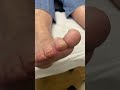 Thick Painful Apex Toe Callus Removal By A Podoatrist