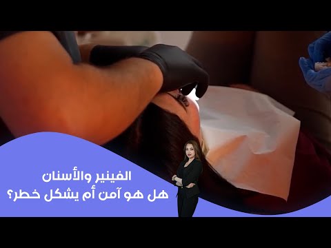 فيديو | الفينير والأسنان هل هو آمن أم يشكل خطر؟