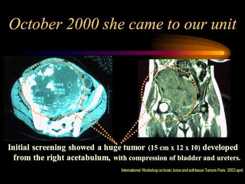 Treatment of advanced pelvic osteosarcoma with chemotherapy directly inside the tumor