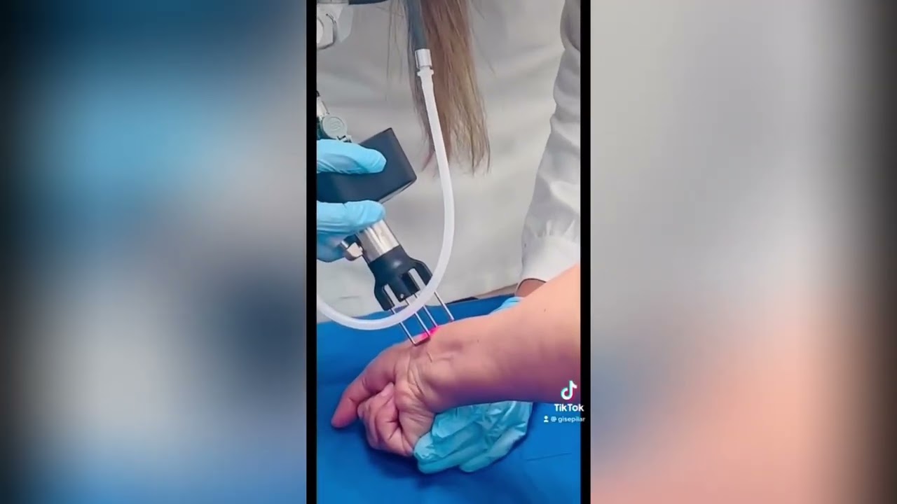 Láser CO2 10600nm para cicatrices atróficas
