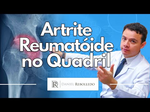 Artrite Reumatoide no Quadril