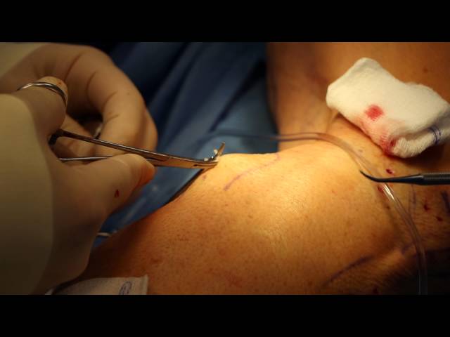 Video pronuncia di avulsion in Inglese