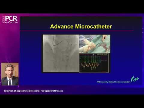 Selection of appropriate devices for retrograde CTO cases at EuroPCR 2020