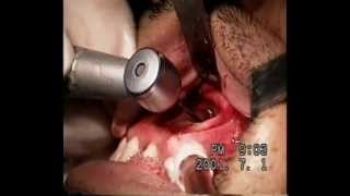 Cirugía de Quiste . Apicectomia