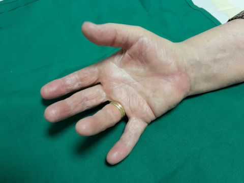 Schnappfinger: So sieht es aus, wenn der Finger schnalzt