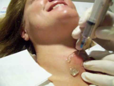 comment traiter les nodules de la thyroide