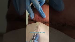 Ácido Hialurónico para las arrugas del entrecejo. - Dr. Angélica Domínguez Dermatóloga en bogotá