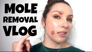 Mole Removal Vlog - Radiofrequency (RF) skin surgery before and after