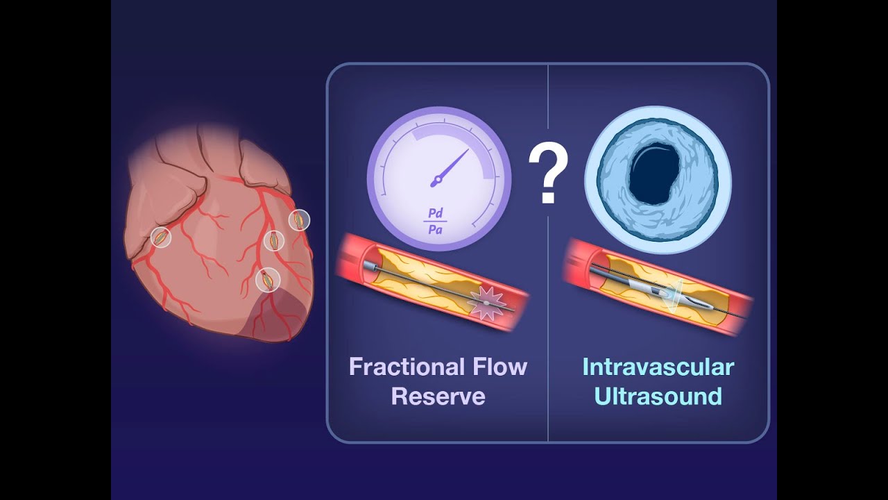 Adjunctive Tools to Guide PCI | NEJM