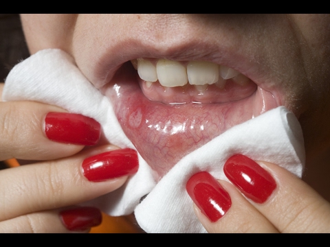 Pasalingsing toenails laser paggamot Clotrimazole paa halamang-singaw paggamot