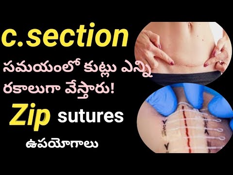 c section stitches types/zip sutures uses/pregnancy care/c section methods