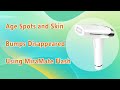 Age Spots and Skin Bumps Disappeared Using MiraMate Flash