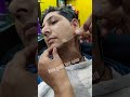 Wart Removal Treatment मस्सा हटाने का उपचार Shorts Massa Skintag S