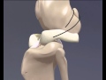 Cranial Cruciate Ligament Rupture - 3D Animation ...