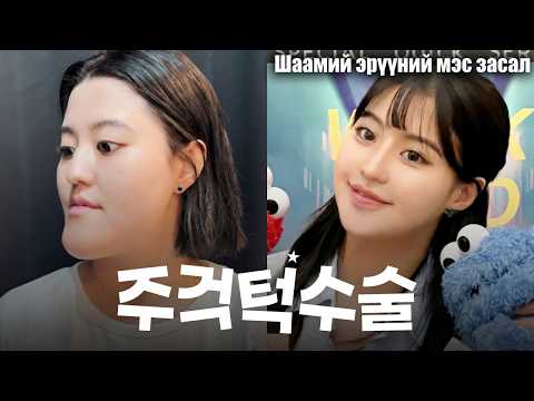 Шаамий эрүүний мэс заслын дараах амьдралын 2 дахь үе эхэллээ | Girin гоо сайхны эмнэлэг