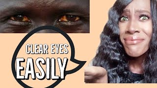 How To Get Rid of Red Eyes|Clear red tired eyes for Africans|You