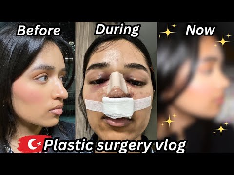 i got a rhinoplasty in TURKEY & documented my entire recovery *nose job vlog*