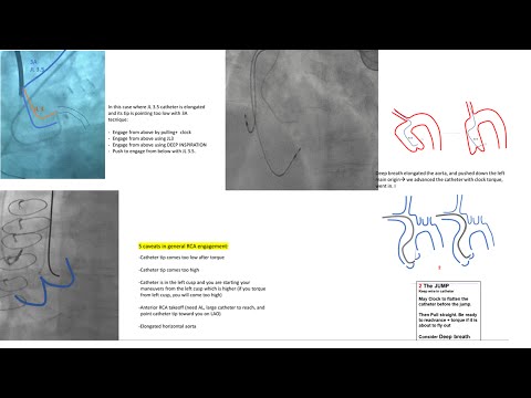 Left+right coronary engagement for general fellows: step-by-step tips, diagrams, caveats (5 for RCA)