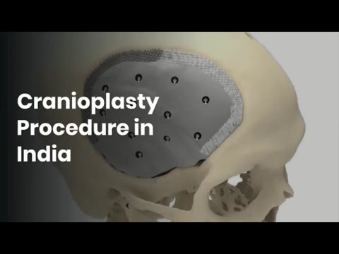 Best Surgery for Cranioplasty treatment in India