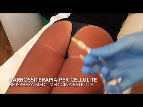 Trattamento della cervicale degenerative unguenti e creme discopatia Dolori articolari primo soccorso
