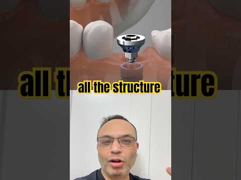 Dental Implant Explained
