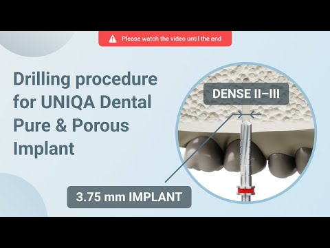 Drilling procedure for UNIQA Dental Pure & Porous Implant UH8 UV11