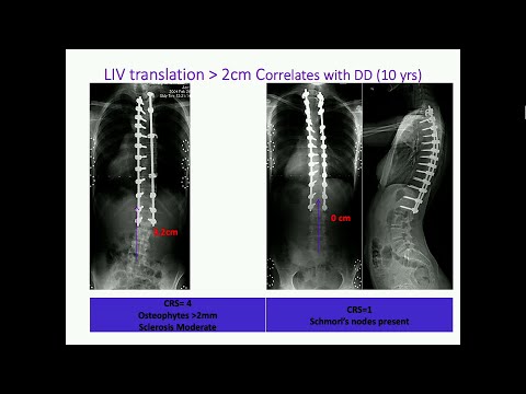 Operative Management of Thoracolumbar Scoliosis: Achieving Optimal Results with Lenke 5 and 6 Curves