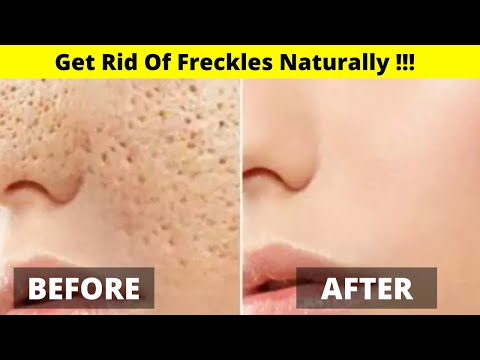 How To Get Rid Of Freckles Permanently || Naturally