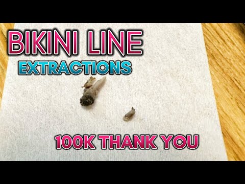 100k‼️ How to Get Rid of Ingrown Hairs on Bikini Line: Expert Tips and Techniques for Smooth Skin