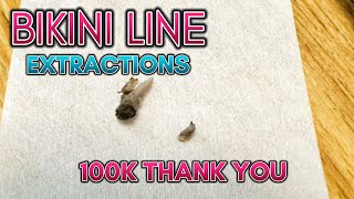 100k‼️ How to Get Rid of Ingrown Hairs on Bikini Line: Expert Tips and Techniques for Smooth Skin