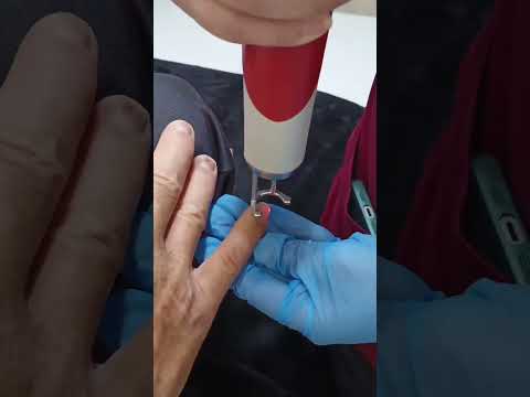 Clear Fungal Nails with Medical Laser | Safe & Painless Treatment