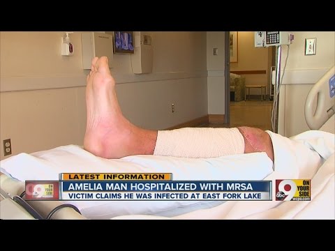 Amelia man hospitalized with MRSA
