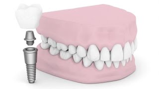 preview picture of video 'Dental Implants: Top 5 Myths and Facts'
