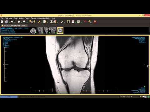 Knöchel Video Hände Verengung der Bandscheibe Thorax