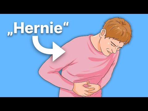 5 Anzeichen einer beginnenden Hernie!