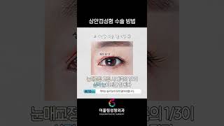 상안검 성형 성형 시술